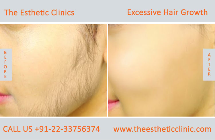 Excessive Hair Growth Removal Treatment before after photos in mumbai india (2)